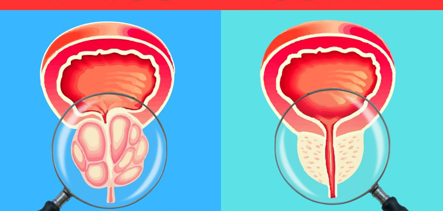Prostate Treatment